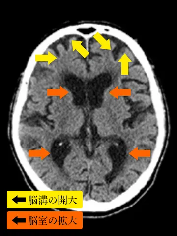 脳溝・脳室の単純CT横断面
