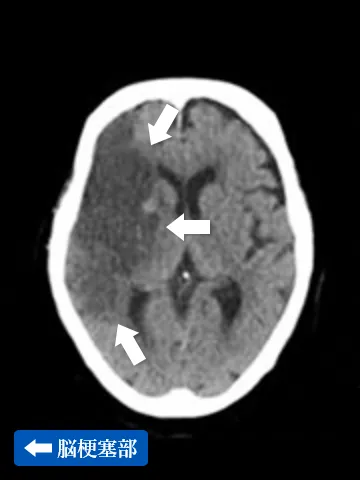 脳梗塞の単純CT画像